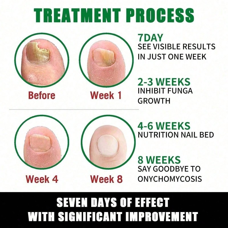 7days Toenail Fungus Treatment Ginger Nail Repair Oil Fungal Nail Repair Patches gallery