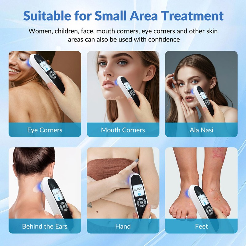 308nm Excimer Phototherapy Device Blue UV Light Therapy for Skin Disorders gallery