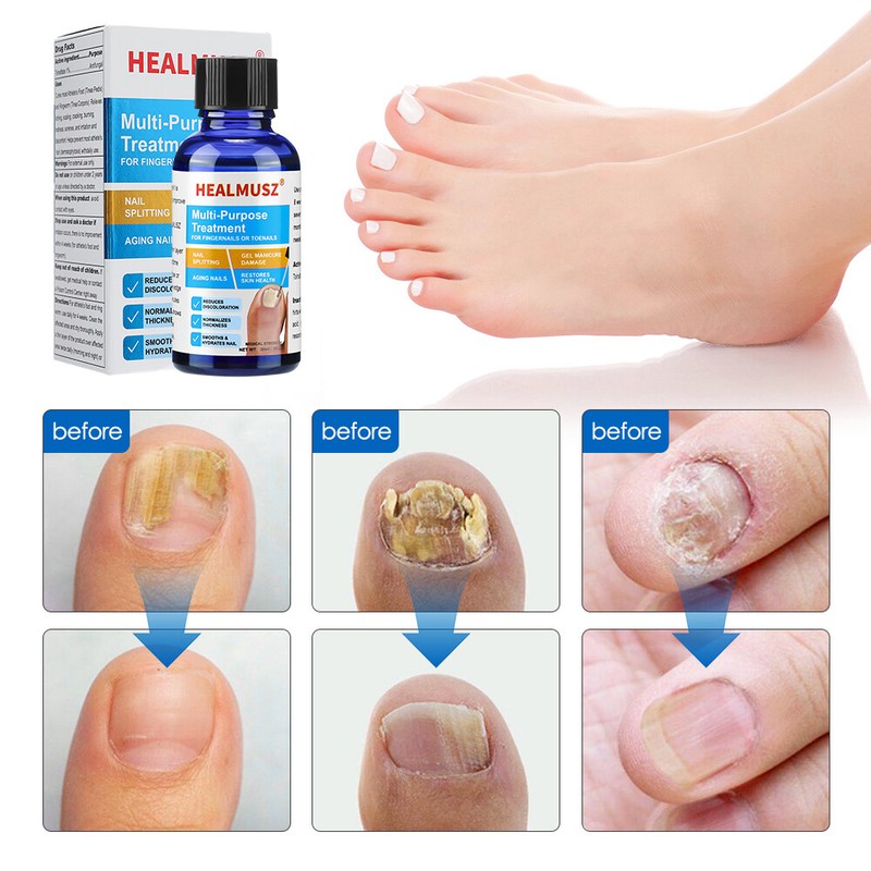 2 Pack Anti Fungal Nail Treatment Toenail Fungus Fungi Nail Repair Foot Care gallery