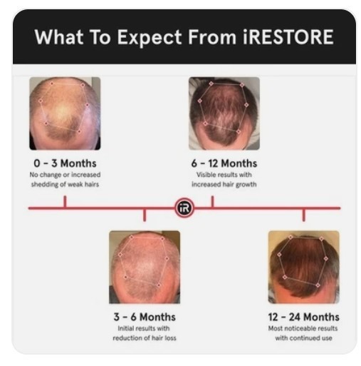 iRESTORE Essential Laser Hair Growth System ID-500 LIGHTY USED, less then 5x) gallery