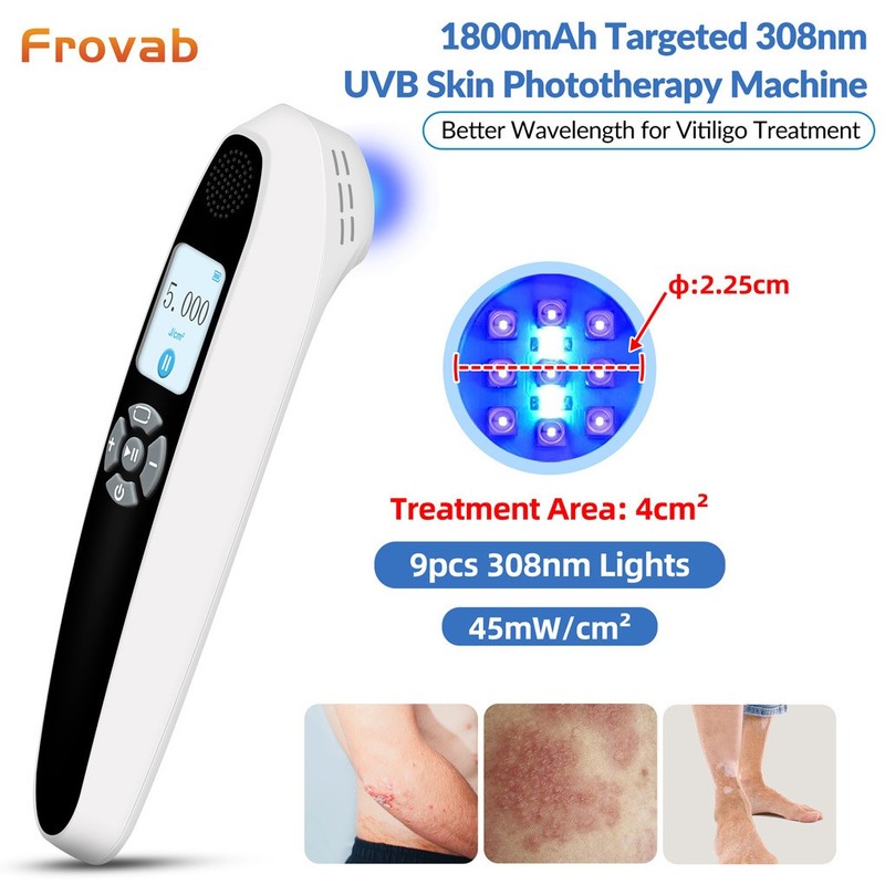 Excimer 308nm Laser Ultraviolet Handheld 45mW/cm² for White Spot Skin At-Home