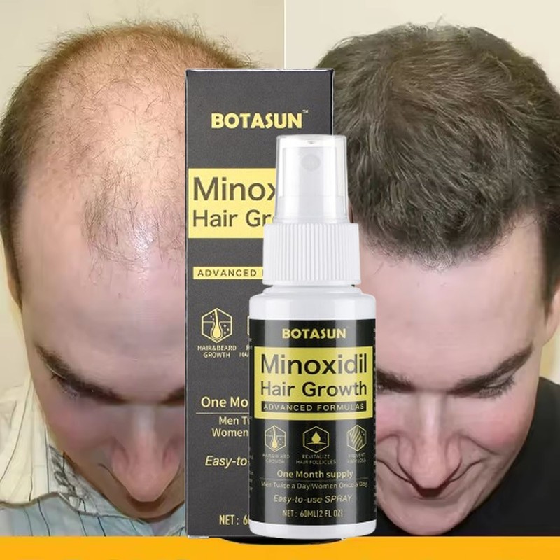 Minoxidil 5% Hair Growth Spray Serum Men Hair Loss Treatment 1 Month Supply 60ML