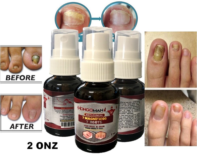 Natural Finger Toe Nail Fungus Topical Anti Fungal support Antifungal 2oz