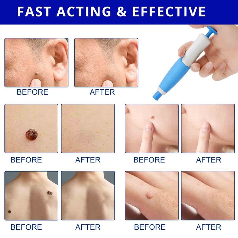 Auto Micro Skin Tag Remover Kit Safe Painless Removal 2-8 mm Band Tool gallery